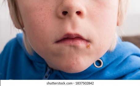 impetigo in children face