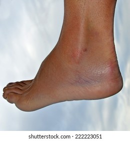 Leg Swelling Images, Stock Photos & Vectors | Shutterstock