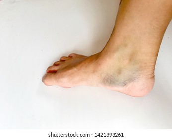 An Ankle Bruise Images, Stock Photos & Vectors | Shutterstock