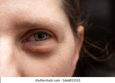 Swelling Of The Eyelid Of A Caucasian Woman's Eye Which Causes Bags Under The Eyes