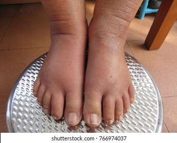 Swelling feet of the old lady on a stainless steel chair, Water retention or edema occurs when excess fluids build up inside your bodyand can be a symptom of a severe medical condition, heart failure