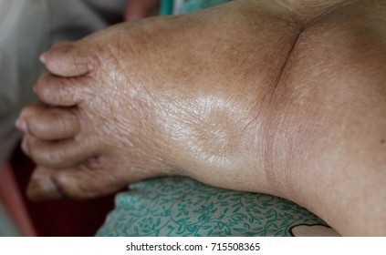 Swelling Foot Of Chronic Patient , Edema , Foot Screening Test