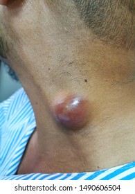 Swelling Of The Lateral Neck With Differential Diagnosis Of Branchial Cyst.