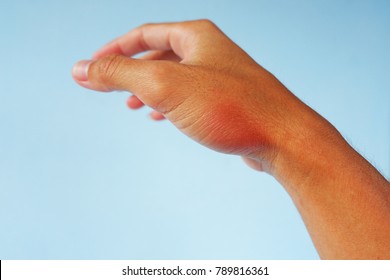 Swelling Symptom Red Skin On Hand Stock Photo 789816361 | Shutterstock