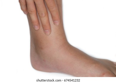 Swollen Ankle Of A Young Woman Due To A Mosquito Bite