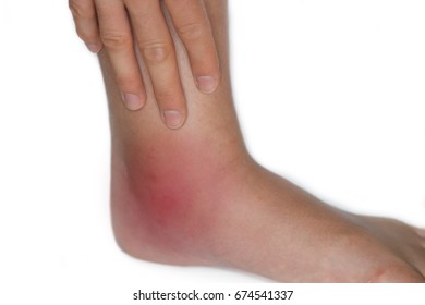 Swollen Ankle Of A Young Woman Due To A Mosquito Bite