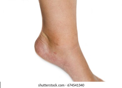 Swollen Ankle Of A Young Woman Due To A Mosquito Bite