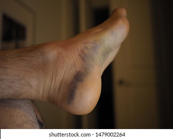Bruised Foot Images, Stock Photos 