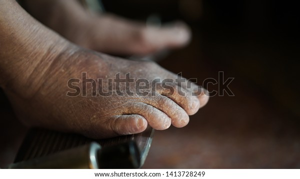 dry swollen feet