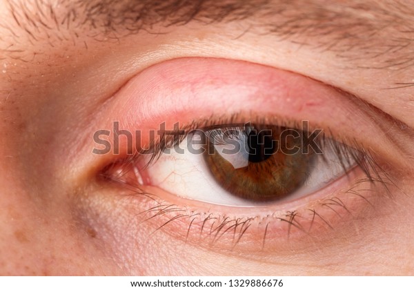 Swollen Eyelid Macro Stock Photo Edit Now 1329886676
