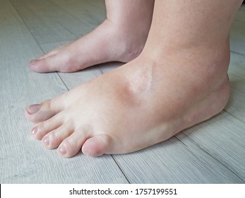 Swollen feets because water retention in the body