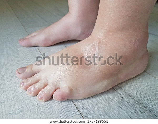 Swollen feets\
because water retention in the\
body
