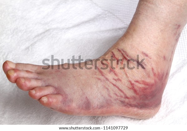 swollen foot after ligament rupture 