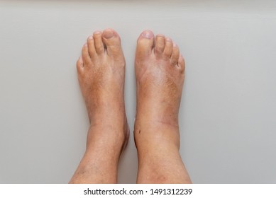 Swollen Foot, Ankle And Leg