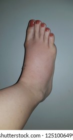 Webbed Toes Syndactyly Affecting Feet Fusion Stock Photo (Edit Now ...