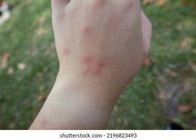 Swollen Hand From Insect Sting, Male Person Showing Swollen Fingers Due To Mosquito Bites, Closeup Of Swollen Hand With Bug Bite And Red Skin.