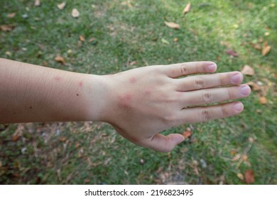 Swollen Hand From Insect Sting, Male Person Showing Swollen Fingers Due To Mosquito Bites, Closeup Of Swollen Hand With Bug Bite And Red Skin.