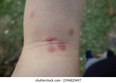 Swollen Hand From Insect Sting, Male Person Showing Swollen Fingers Due To Mosquito Bites, Closeup Of Swollen Hand With Bug Bite And Red Skin.