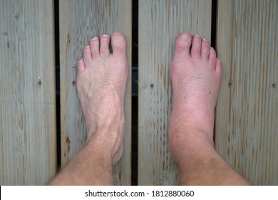 Swollen inflamed foot of a man suffering an allergic reaction to the sting or bite of an insect looking down at his feet on a wooden floor with the healthy one for comparison - Shutterstock ID 1812880060