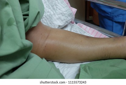 Swollen Left Forearm Due To Thrombophlebitis.