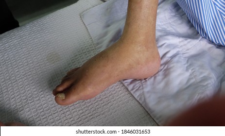 Swollen Leg With Pedal Oedema Demonstrated By Pressing Against The Medial Aspect Of Lower Limb. 