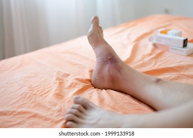 Swollen man's feet as a skin reaction on insect bite, resting in bed 