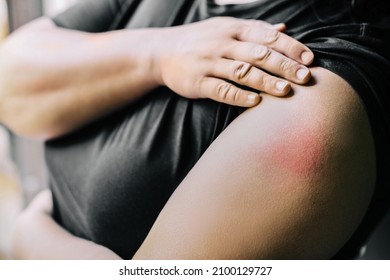 Swollen Red After Vaccine Reaction At The Injection Site. Arm Of Woman 48 Hours After Receiving Covid-19 Coronovirus Vaccination.