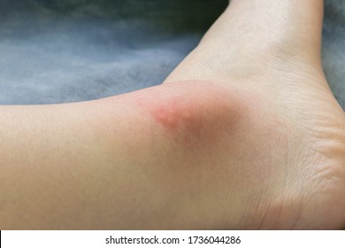 
Swollen And Red Ankle After Mosquito Bite