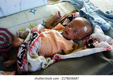 Sylhet Bangladesh 15 July 2022: A Newborn Baby Is Suffering From Malnutrition Due To Floods In Sylhet.                       