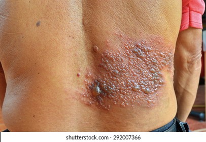 Symptom of Herpes zoster virus on back.