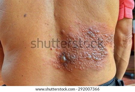 Symptom Herpes Zoster Virus On Back Stockfoto Jetzt Bearbeiten