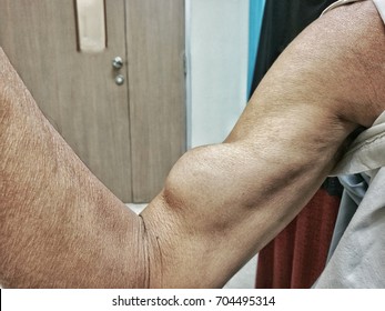 Symptom Of Rupture Of Biceps Tendon  Due To Hard Work . Contraction  And Show Mass In Biceps Muscle 
