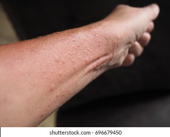 Symptoms Of Contact Allergy On Hand's Skin. Close Up Of Hives.