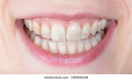 Symptoms Of Demineralization Of The Teeth. Visible Signs Of Transparency Of The Tooth. Dental Damaged Erosion Concept. Loss Of The Reinforcement Of The Enamel.