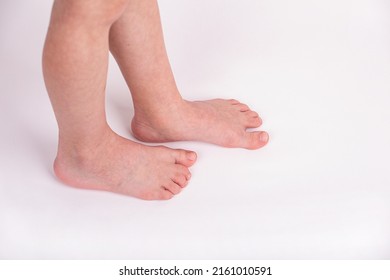 Syndactyly. Fused Toes Of A Child, On A Light Background