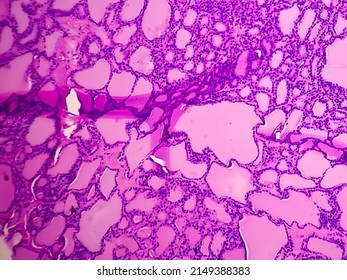 Synovial Sarcoma Histology Image Analyzed By Light Microscope At Histopathology Laboratory. Cancer Cells 1000x Zooming Micrograph.