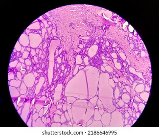 Synovial Sarcoma Histology Image Analyzed By Light Microscope At Histopathology Laboratory. Cancer Cells 1000x Zooming Micrograph.