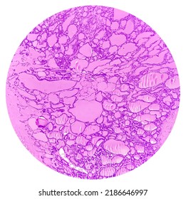 Synovial Sarcoma Histology Image Analyzed By Light Microscope At Histopathology Laboratory. Cancer Cells 1000x Zooming Micrograph.