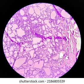 Synovial Sarcoma Histology Image Analyzed By Light Microscope At Histopathology Laboratory. Cancer Cells 1000x Zooming Micrograph.