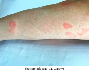 Systemic Lupus Erythematosussle Chronic Disease Caused Stock Photo ...