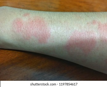 729 Systemic lupus erythematosus Images, Stock Photos & Vectors ...