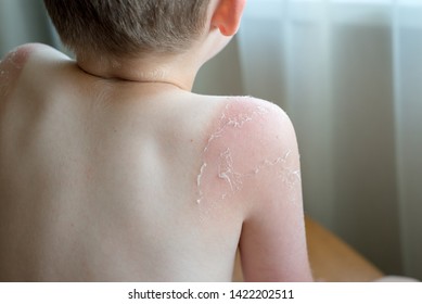Tan On The Shoulder Of A Child. Skin, Red Skin, Blisters And Peeled Skin. Step By Step. Sun Protection. Need To See A Doctor