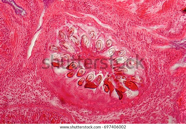 Tapeworm Parasite >> Tapeworm Parasite Echinococcus Granulosus Liver Light Stock Tapeworm Parasite >> Tapeworm Parasite Echinococcus Granulosus Liver Light Stock