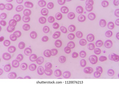 Target Cell On Blood Smear Patient Stock Photo 1120076213 