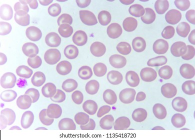 Target Cells Abnormal Red Blood Cell Stock Photo 416734024 | Shutterstock