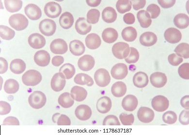 Target Cells Abnormal Red Blood Cells Stock Photo 1167226609 | Shutterstock