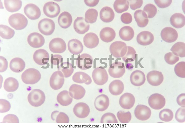 Target Cells Abnormal Red Blood Cells Stock Photo (Edit Now) 1178637187