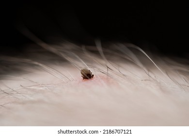 Teak With Its Chelicerae Adhering To Human Skin.