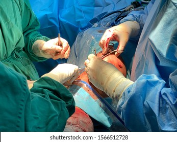 Team Of Orthopedic Surgeon Performing Suturing On A Patient's Knee. Selective Focus