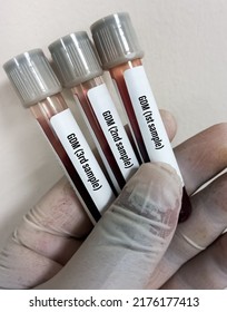 Technologist holding sample tubes of GDM(Gestational Diabetes Mellitus) test for diagnosis of hyperglycemia or hypoglycemia, oral glucose tolerance test (OGTT).